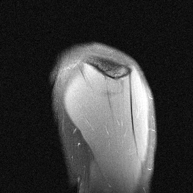 Shoulder coronal RSS sample