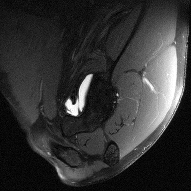 Shoulder sagittal RSS sample