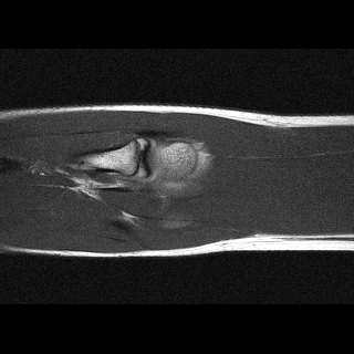 Coronal sample